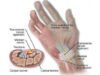 Ini Dia Pengertian CTS (Carpal Tunnel Syndrome)